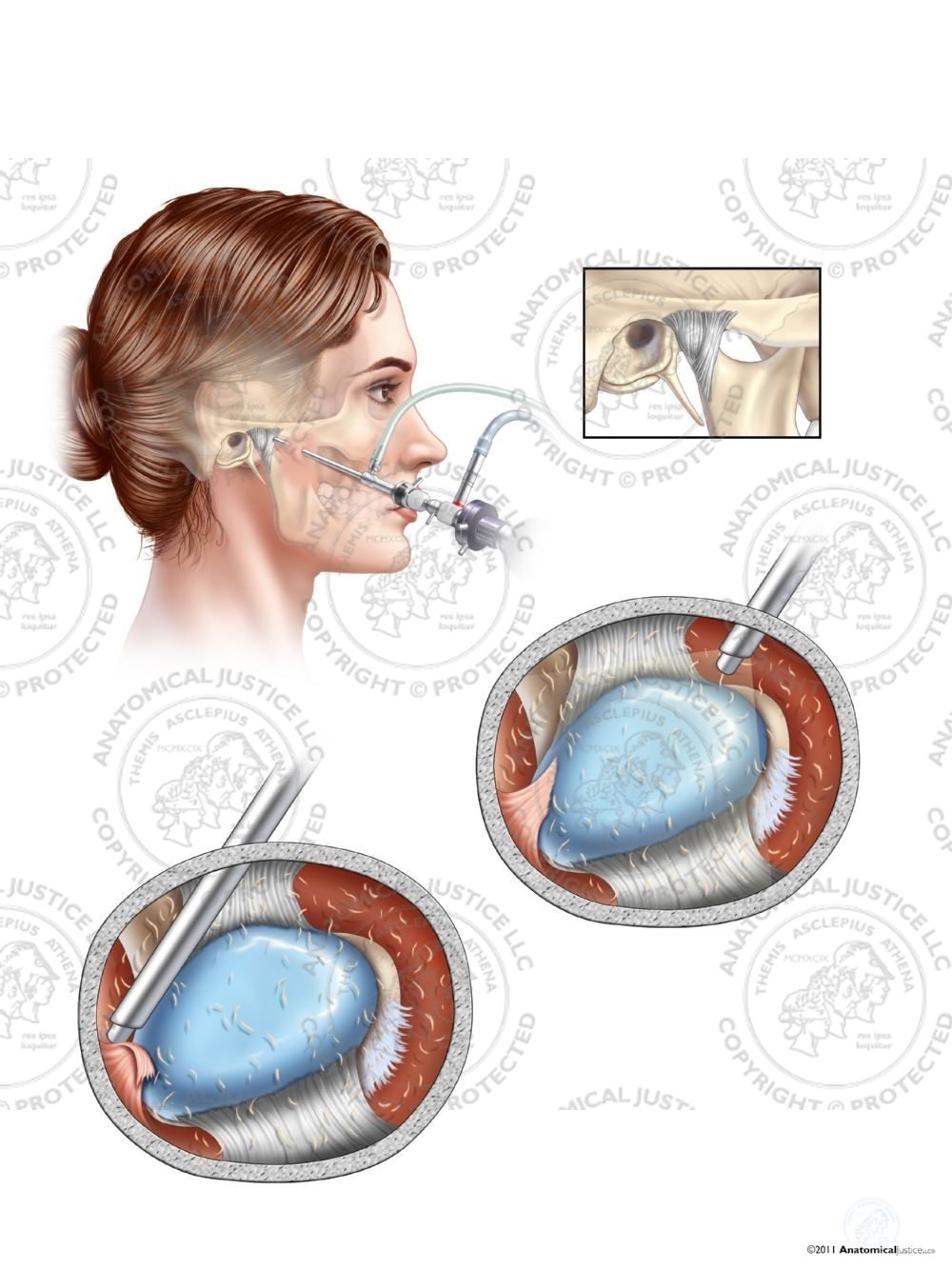 Female Arthroscopic Surgery of the Right Temporomandibular Joint (TMJ) – No Text