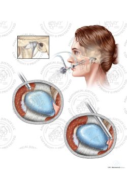 Female Arthroscopic Surgery of the Left Temporomandibular Joint (TMJ) – No Text