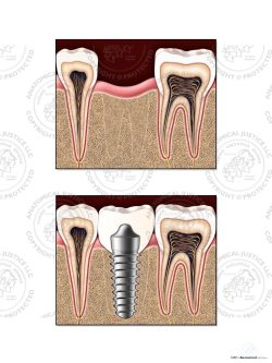 Dental Implant – No Text