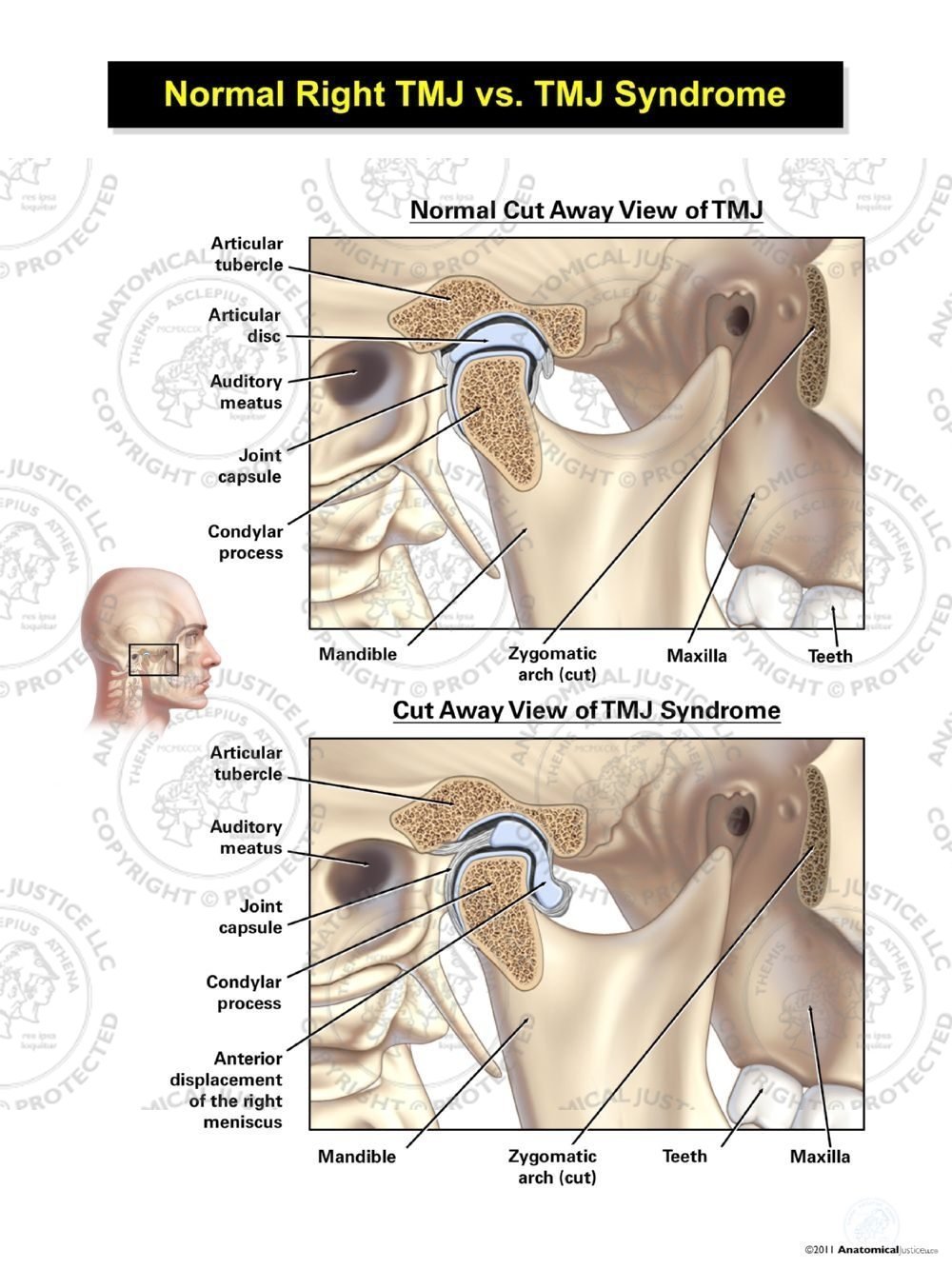 Normal Right TMJ vs. TMJ Syndrome