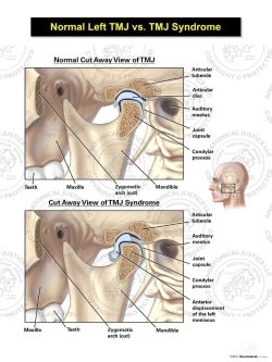 Normal Left TMJ vs. TMJ Syndrome