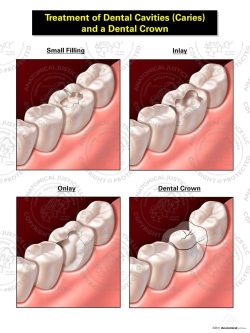 Treatment of Dental Cavities (Caries) and a Dental Crown