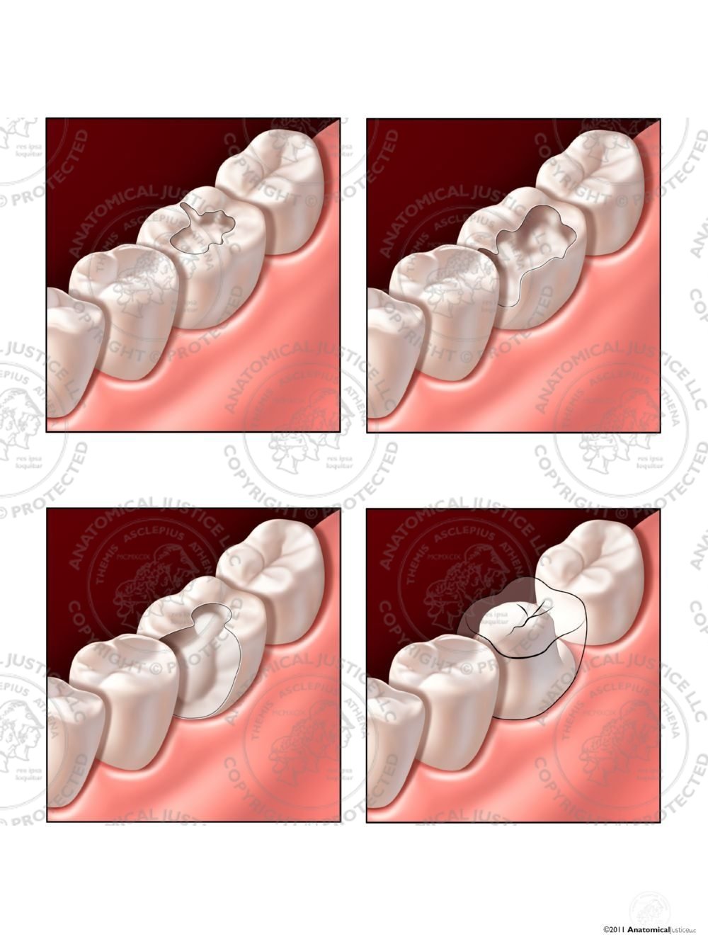 Treatment of Dental Cavities (Caries) and a Dental Crown – No Text