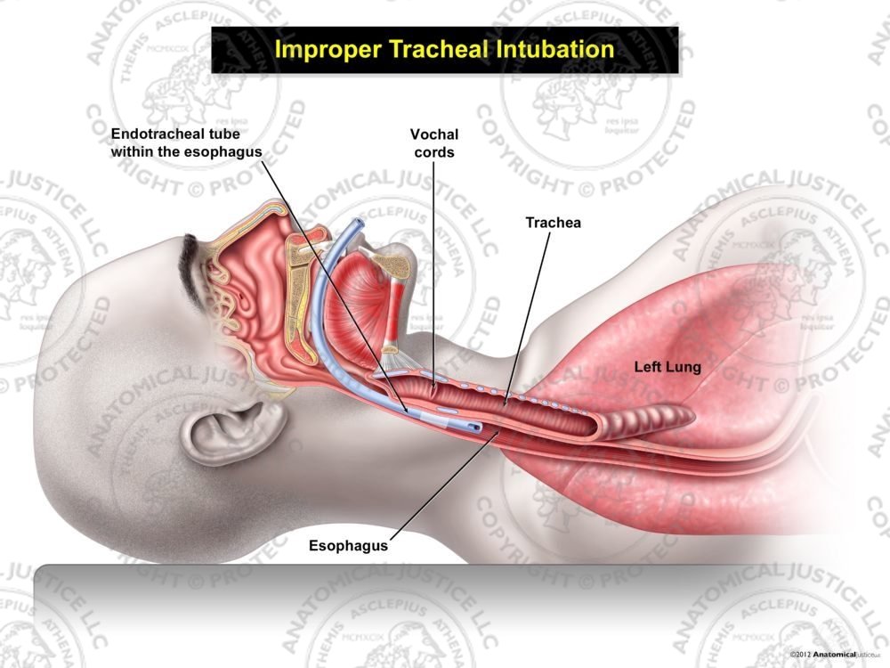 Improper Male Tracheal Intubation
