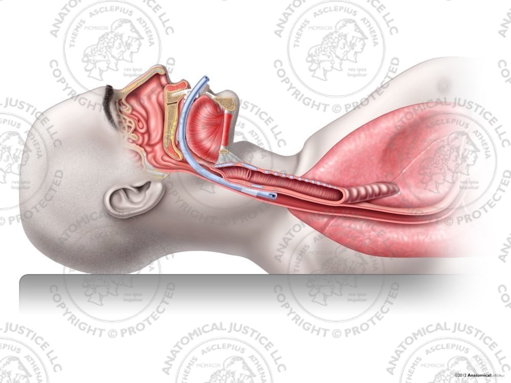 Improper Male Tracheal Intubation – No Text