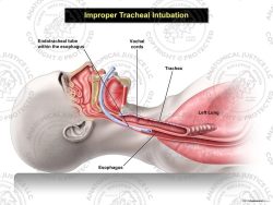 Improper Female Tracheal Intubation