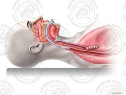 Improper Female Tracheal Intubation – No Text