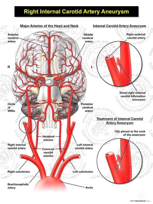 Right Internal Carotid Artery Aneurysm