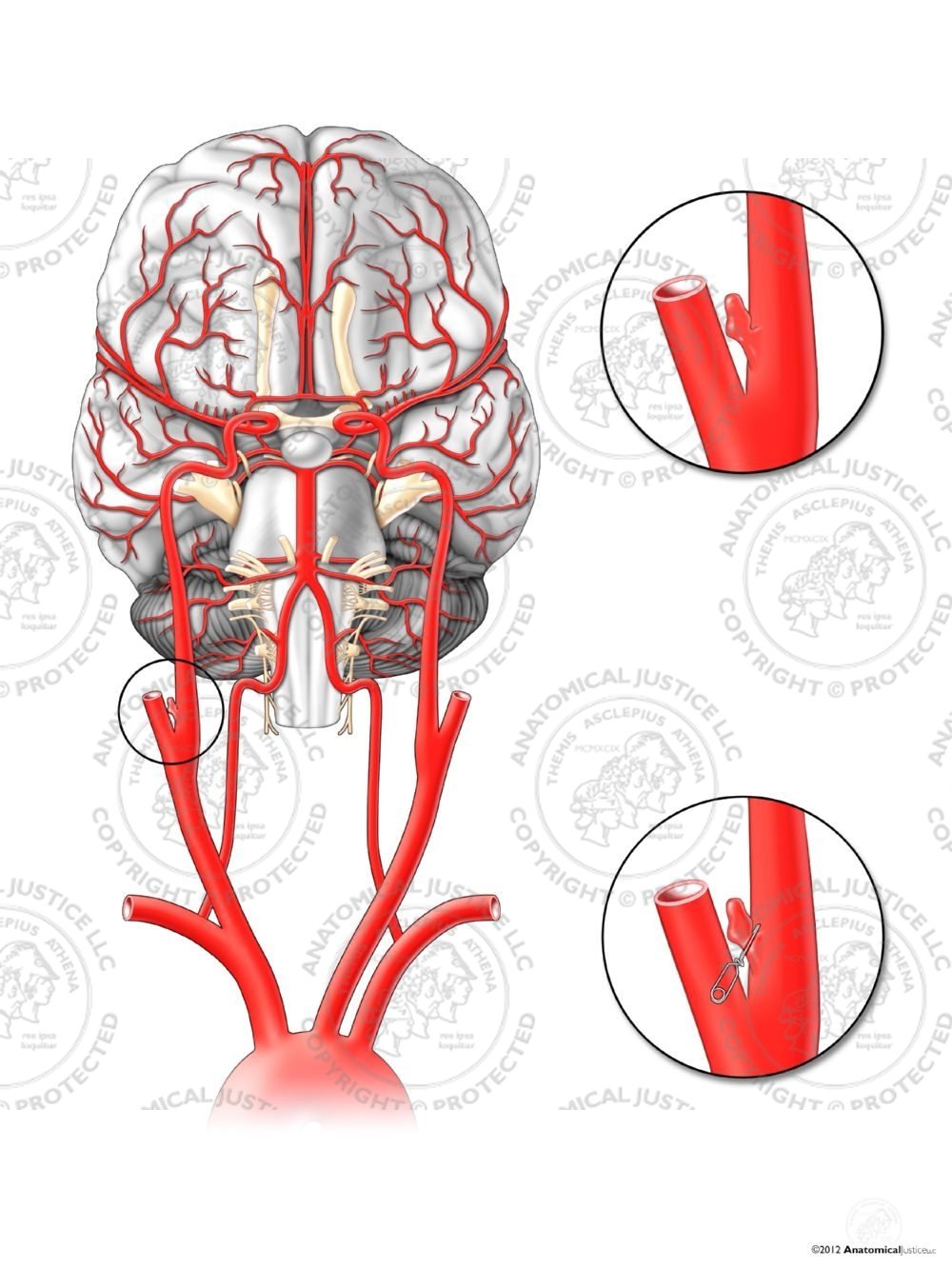 Right Internal Carotid Artery Aneurysm – No Text