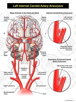Left Internal Carotid Artery Aneurysm
