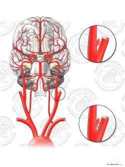 Left Internal Carotid Artery Aneurysm – No Text