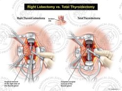 Male Left Lobectomy vs. Total Thyroidectomy