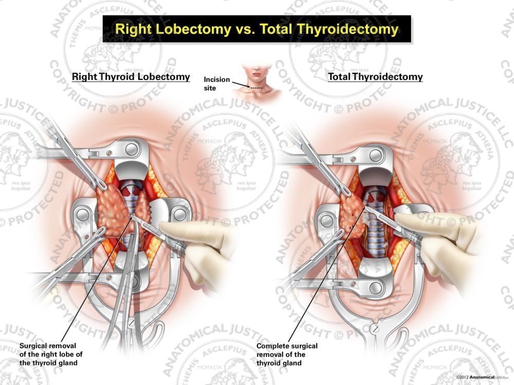 Female Left Lobectomy vs. Total Thyroidectomy