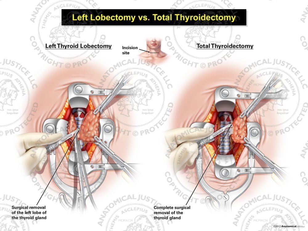 Male Left Lobectomy vs. Total Thyroidectomy
