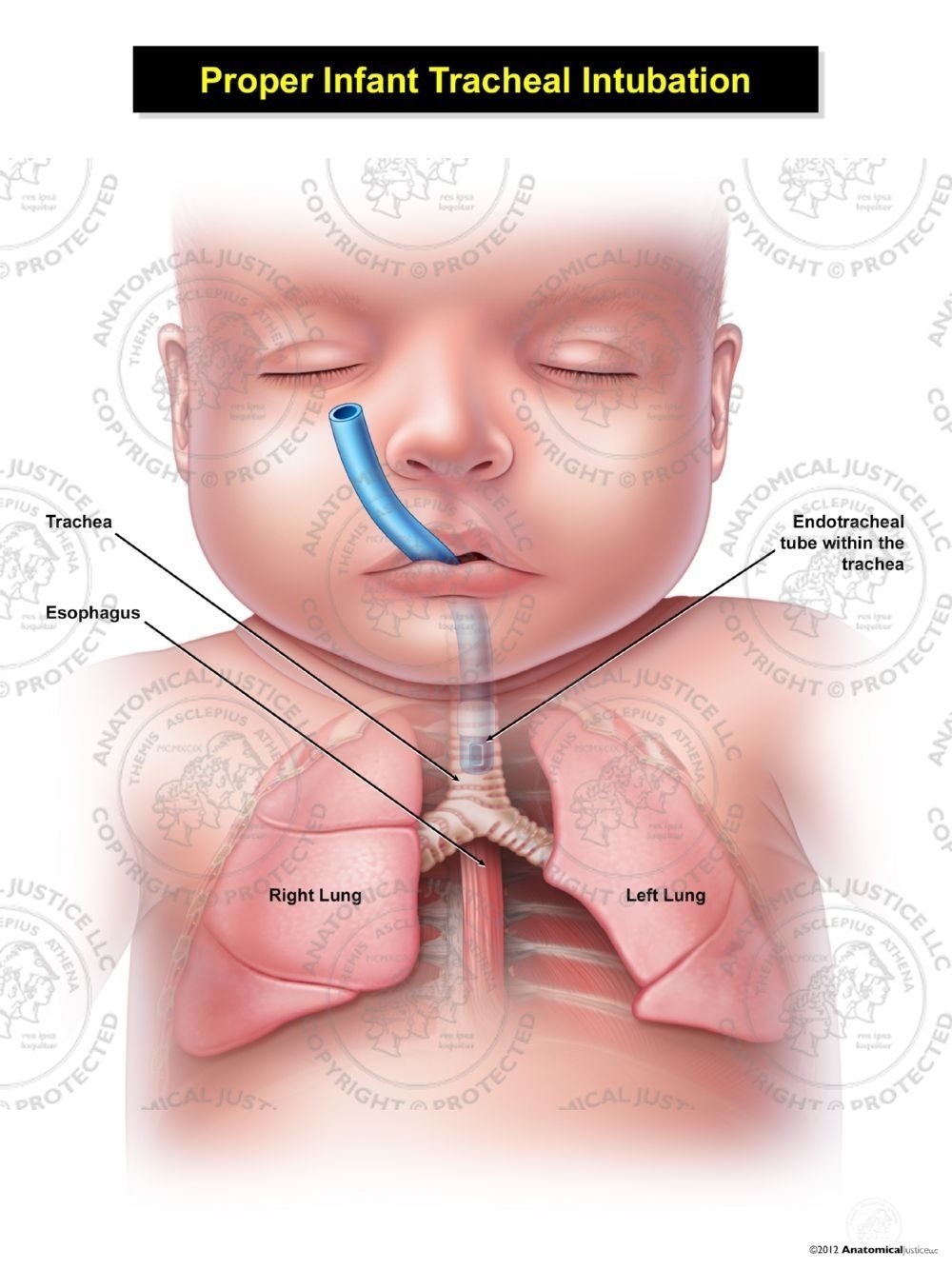 Proper Infant Tracheal Intubation