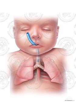 Proper Infant Tracheal Intubation – No Text