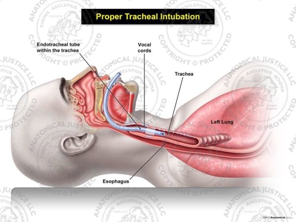 Tracheal Intubation exhibit shows intubated male with cross sectional anatomy