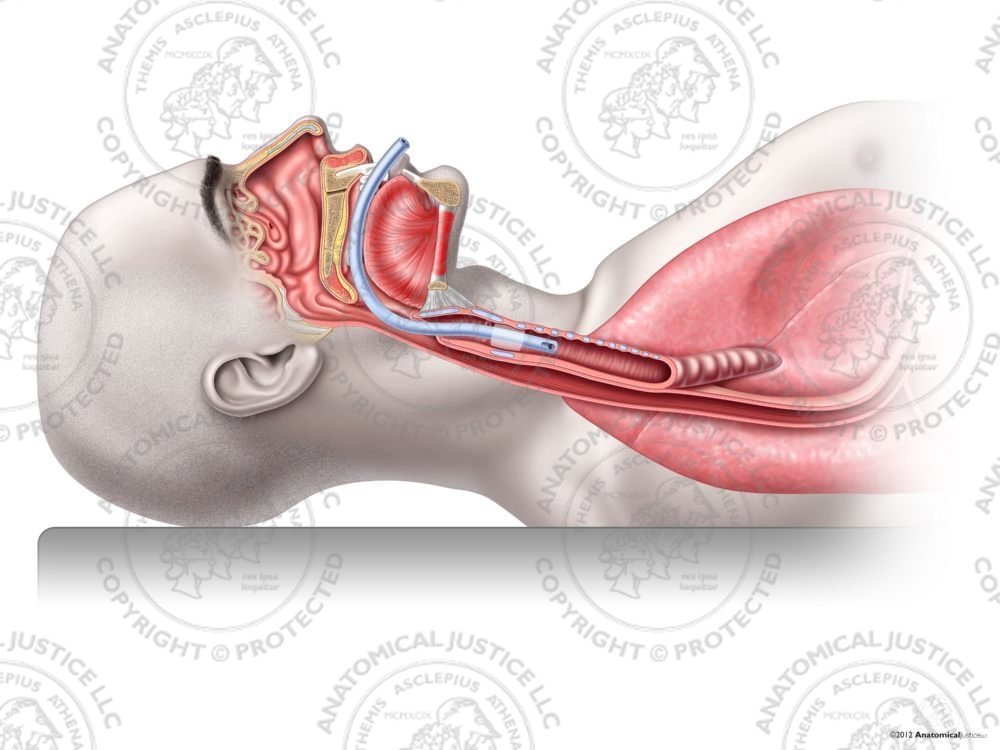 Proper Male Tracheal Intubation – No Text