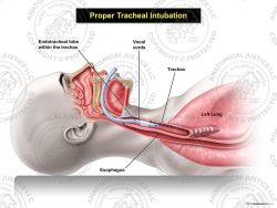 Proper Female Tracheal Intubation