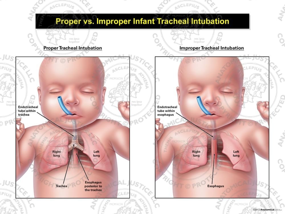 Proper vs. Improper Infant Tracheal Intubation
