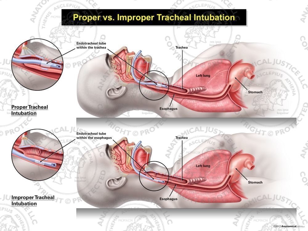 Male Proper vs. Improper Tracheal Intubation