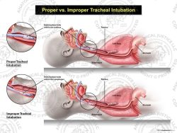 Female Proper vs. Improper Tracheal Intubation