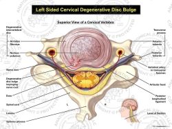 Left Cervical Degenerative Disc Bulge