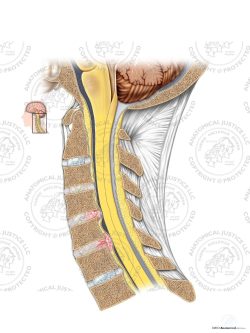 Cervical Degenerative Disc Bulge and Herniation – No Text