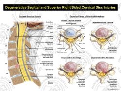 Cervical Degenerative Disc Disease with Right Disc Injuries