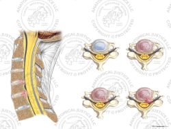 Cervical Degenerative Disc Disease with Right Disc Injuries – No Text