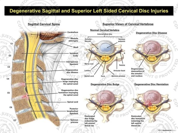 Degenerative disc disease is shown sagittally and in four supeiror illustrations with varying degrees of disc injury.