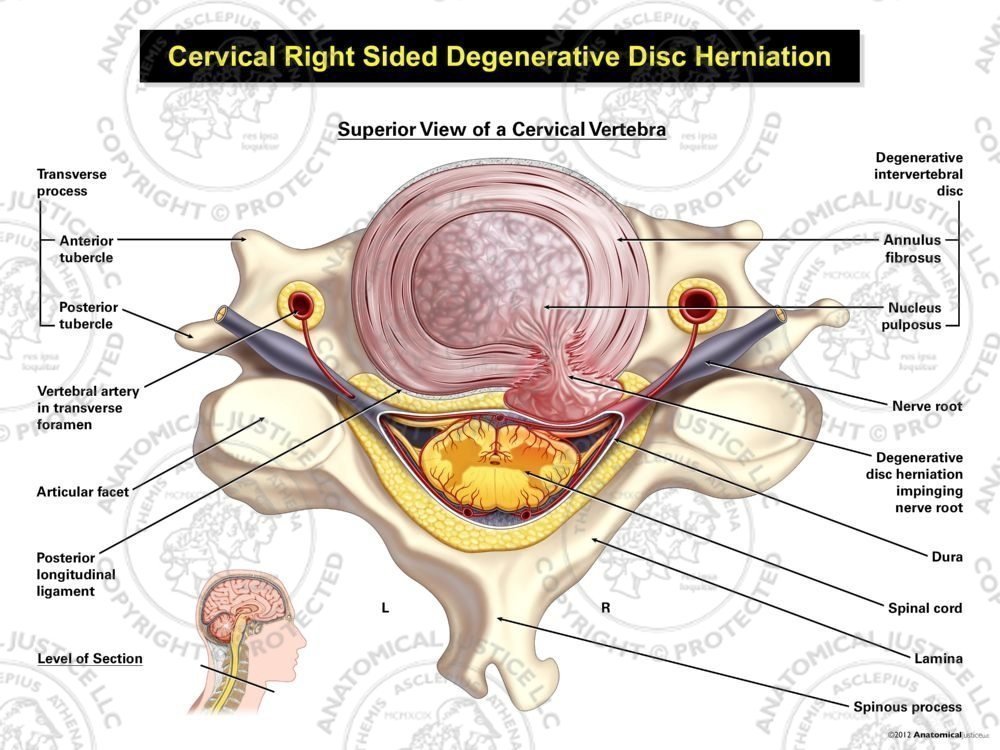 Right Cervical Degenerative Disc Herniation