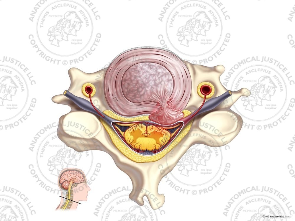 Right Cervical Degenerative Disc Herniation – No Text