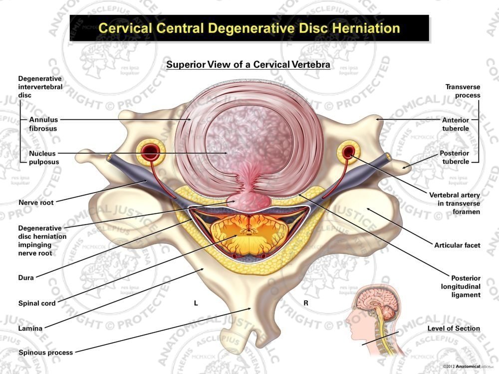 Central Cervical Degenerative Disc Herniation