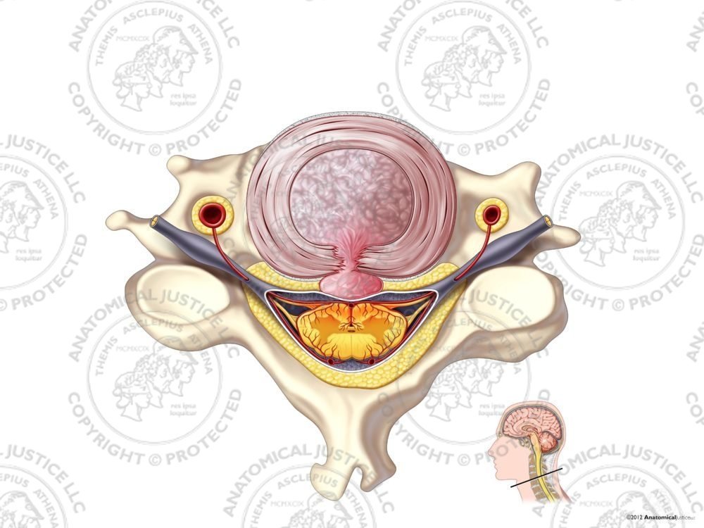 Central Cervical Degenerative Disc Herniation – No Text