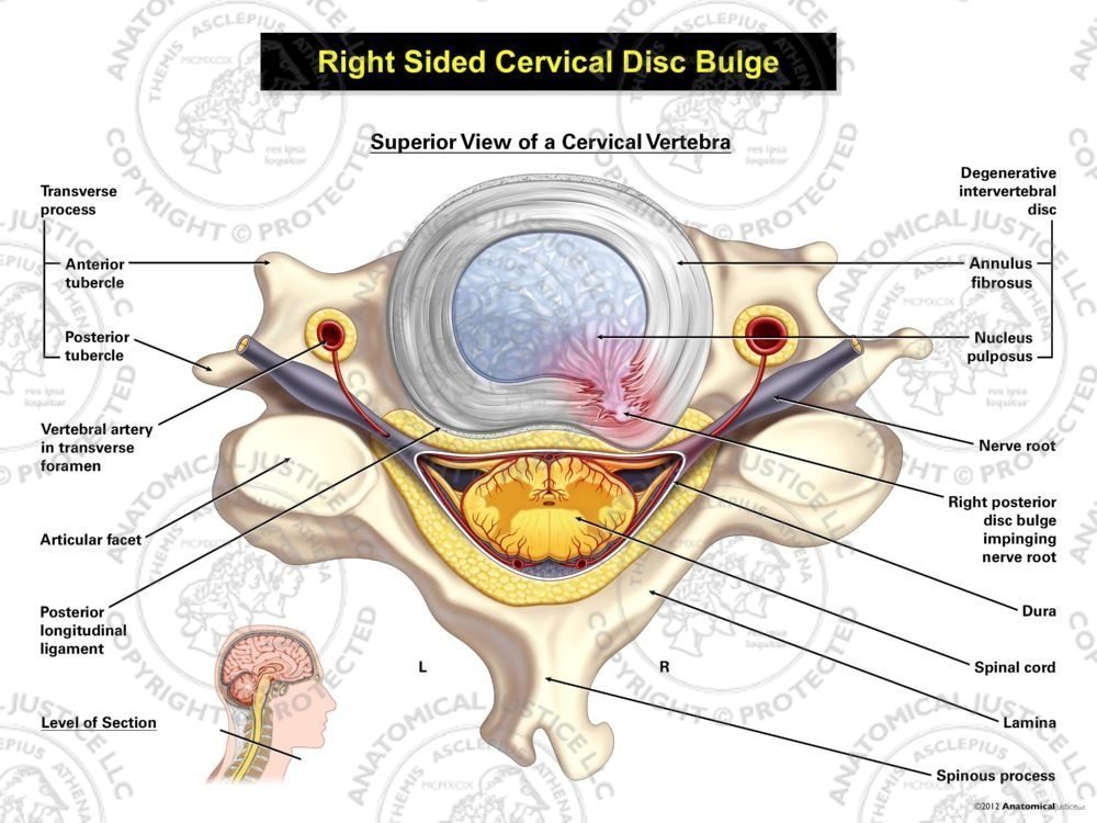 Right Cervical Disc Bulge