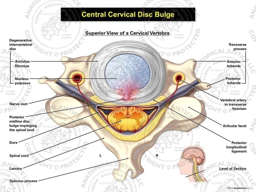 Central Cervical Disc Bulge