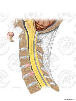 Cervical Disc Bulge and Herniation – No Text