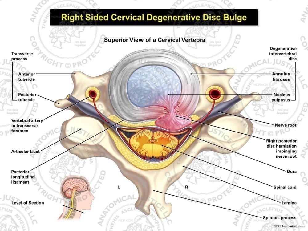 Right Cervical Disc Herniation