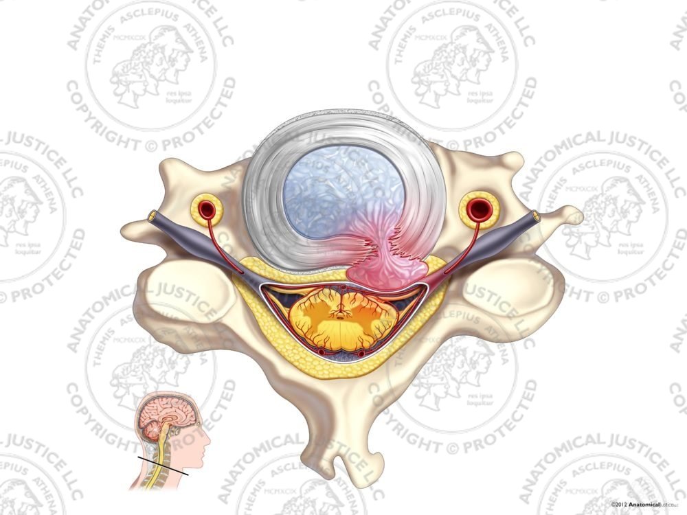 Right Cervical Disc Herniation – No Text