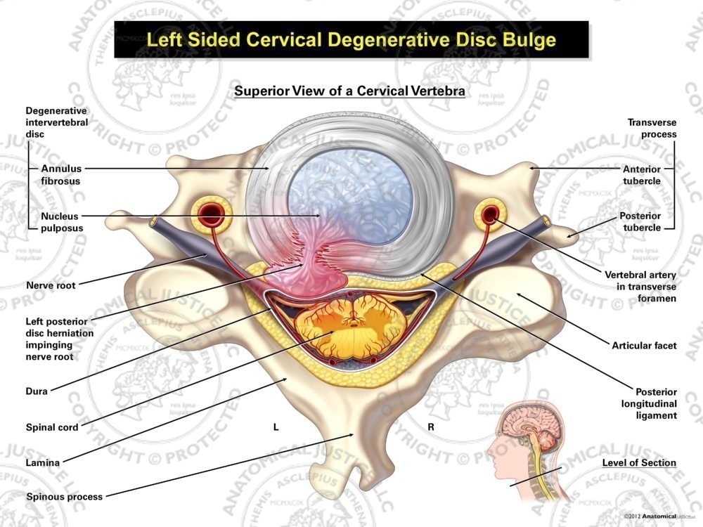 Left Cervical Disc Herniation