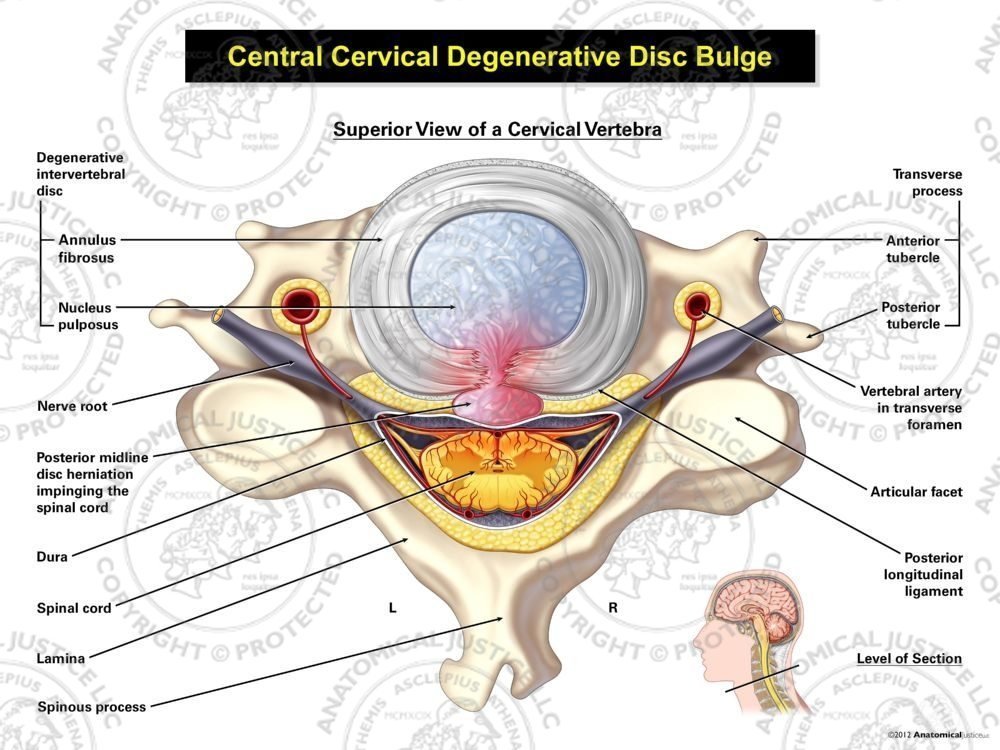 Central Cervical Disc Herniation