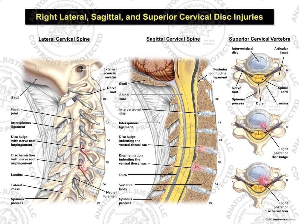 Right Lateral, Sagittal, and Superior Cervical Disc Injuries