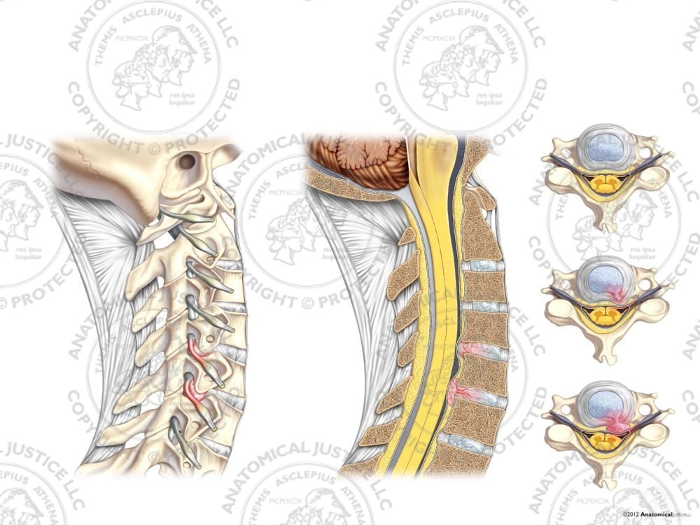 Right Lateral, Sagittal, and Superior Cervical Disc Injuries – No Text
