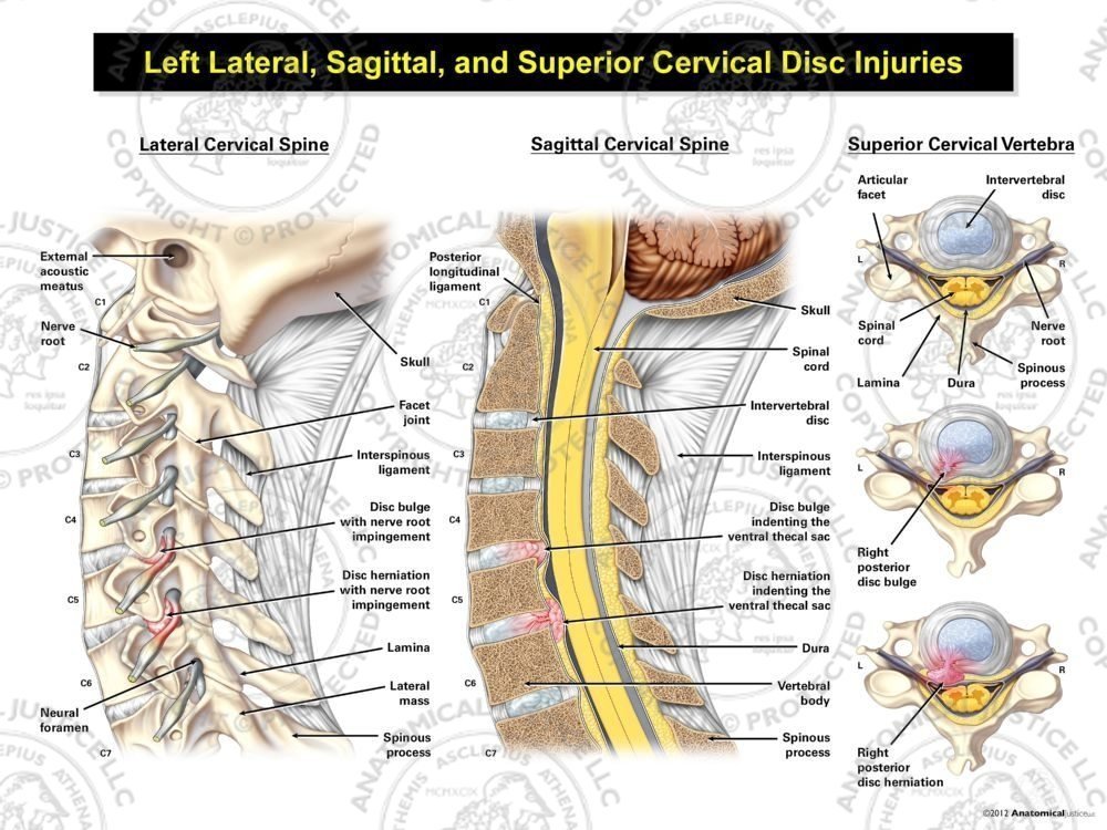 Left Lateral, Sagittal, and Superior Cervical Disc Injuries