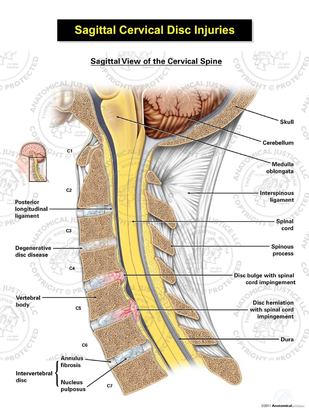 Sagittal Cervical Disc Injuries