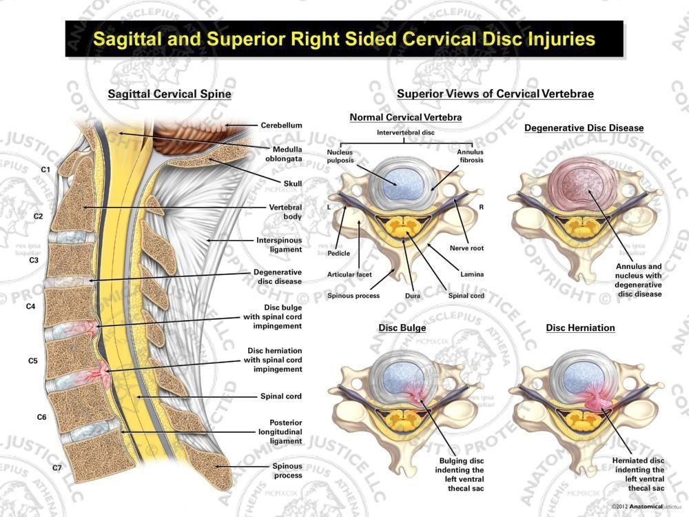 Right Sagittal and Superior Cervical Disc Injuries