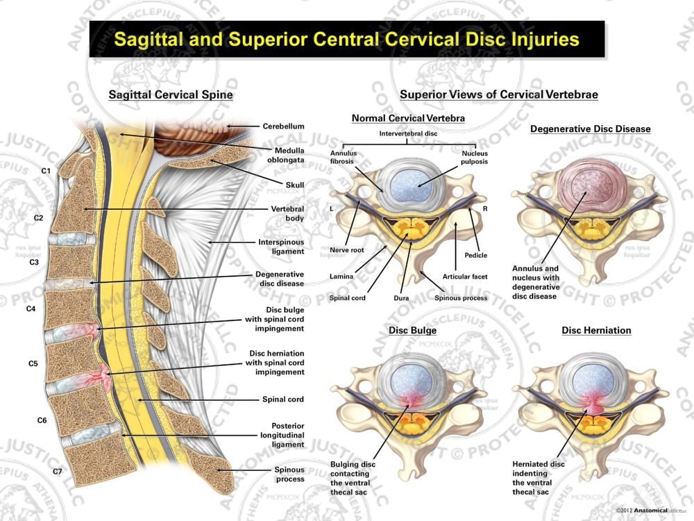 Sagittal and Superior Central Cervical Disc Injuries
