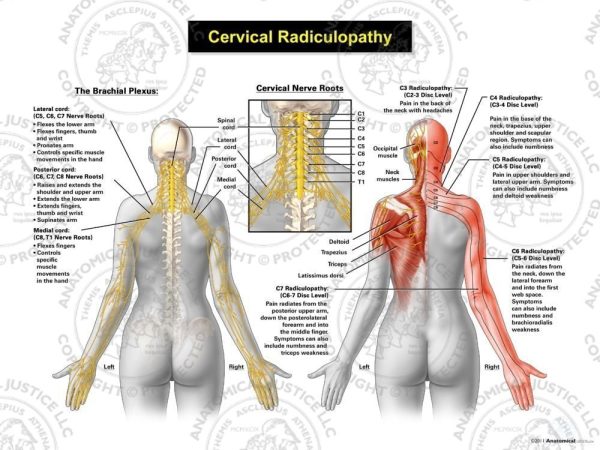 Cervical Radiculopathy exhibit shows two posterior female illustrations with an enlargement of the posterior neck in the middle showing the brachial plexus, nerve roots, and dermatomes.