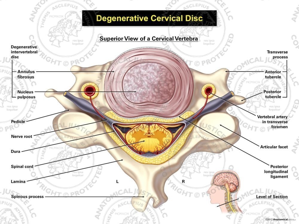 Degenerative Cervical Disc